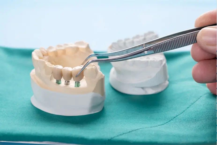 A model jaw fitted with implant abutments for a retained denture