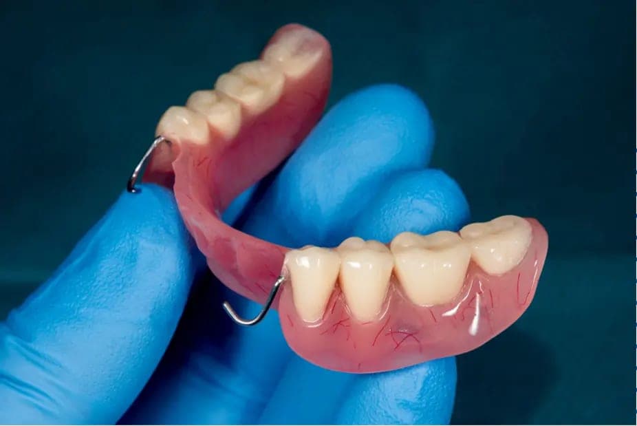 A gloved hand holding a partial denture with its metal clasps