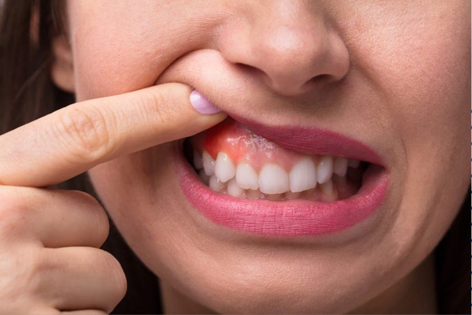 A lifted lip showing reddened, inflamed gum tissue