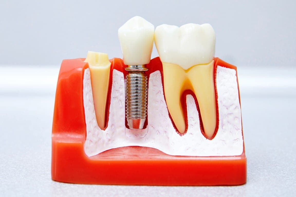 A cutaway model of a single implant in bone beside a natural tooth