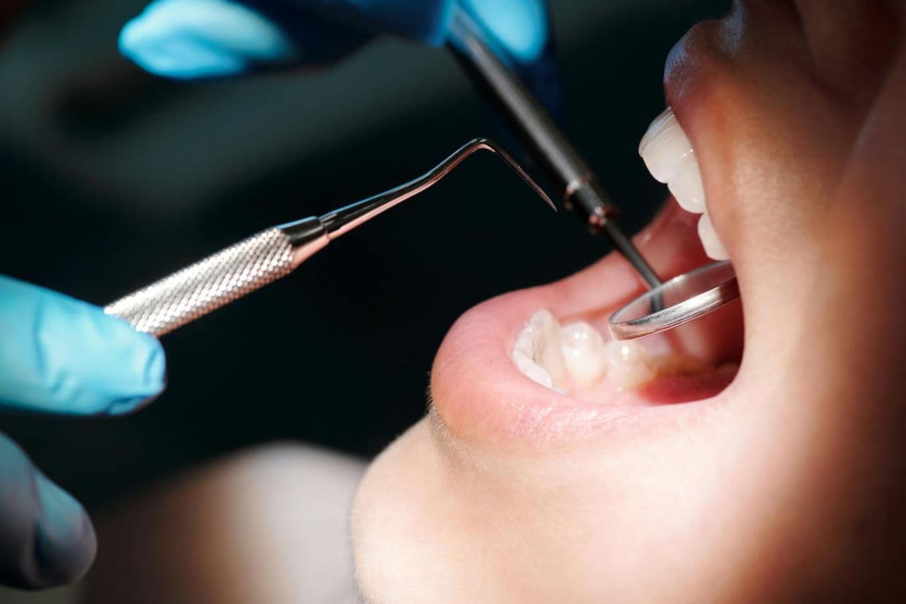 A scaler and mirror worked along the lower gum line during a deep clean