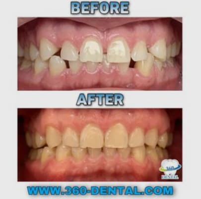 Before and after composite: spacing closed across the upper front teeth