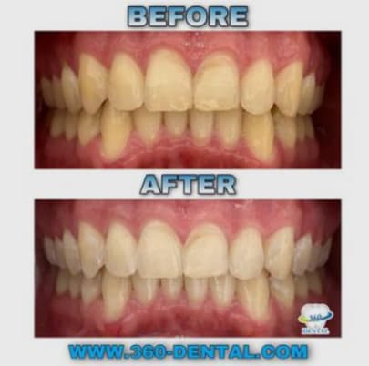 Before and after composite: a full upper and lower smile restoration