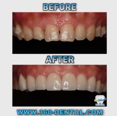 Before and after composite: worn and chipped front teeth rebuilt