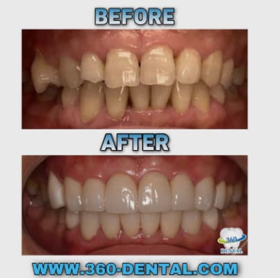 Before and after composite: a full smile makeover on both arches