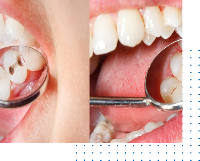 Composite Dental Fillings Near me Open Now