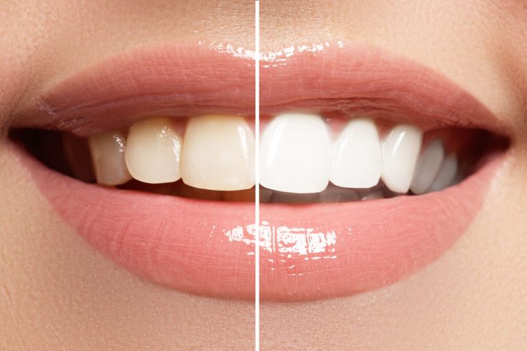 Read more about the article Bananas and Teeth Whitening: Separating Fact From Fiction